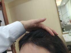 -碧莲盛·不剃发植发