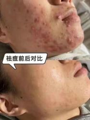-成都苗方清颜专业祛痘