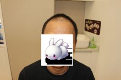 -大麦微针植发丨全国连锁