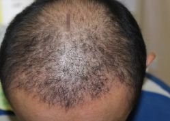 -大麦微针植发丨全国连锁