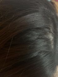 -碧莲盛·不剃发植发