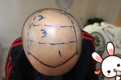 -大麦微针植发丨全国连锁