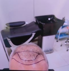 -碧莲盛·不剃发植发