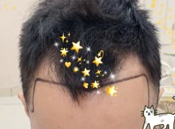 -大麦微针植发全国连锁