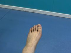 -Andrew指甲专科灰指甲·甲沟炎矫正·3D步态矫形鞋垫定制(浦三路店)