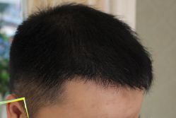 -大麦微针植发丨全国连锁