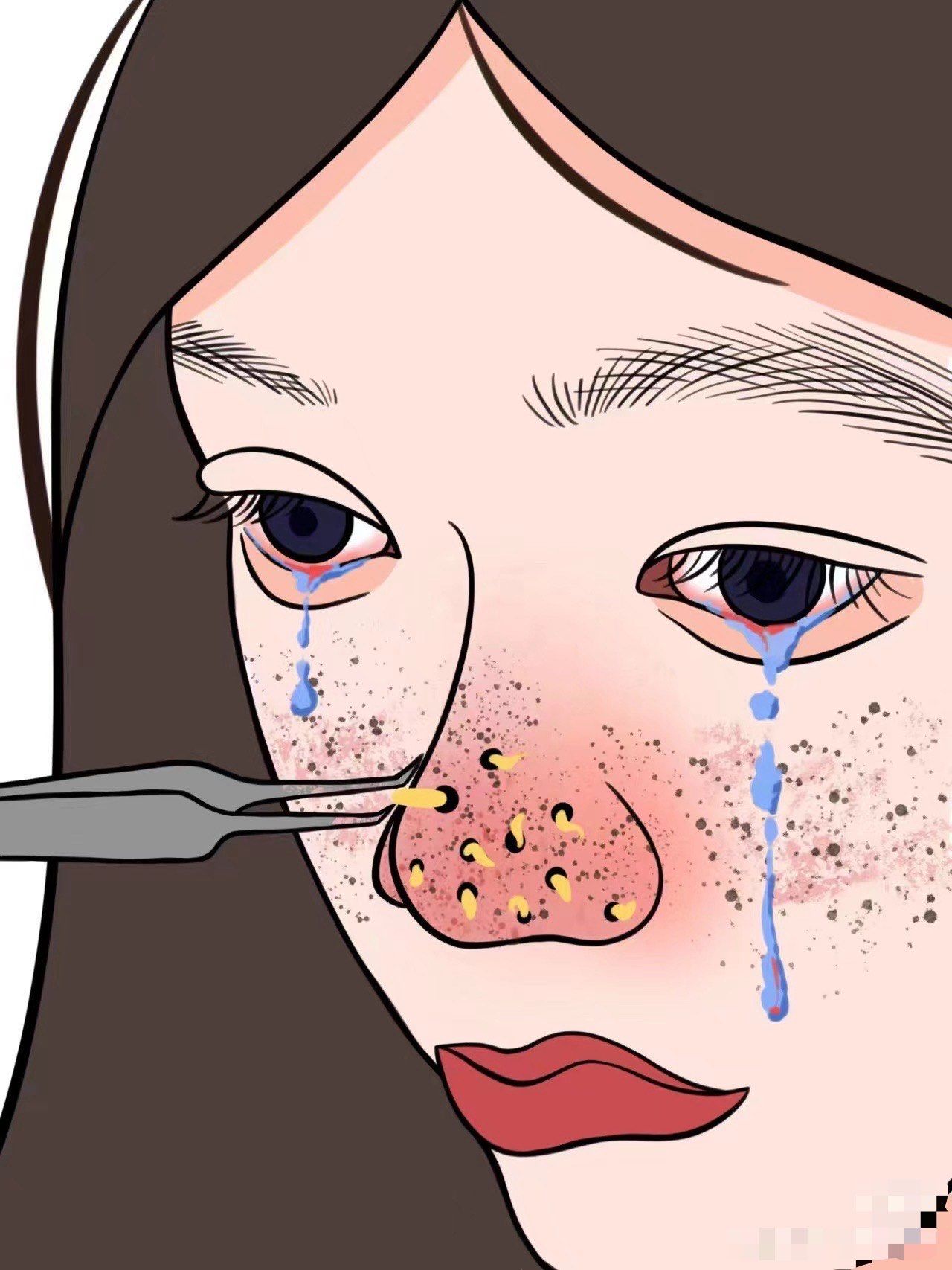 黑头越清越多怎办