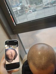 -碧莲盛·不剃发植发