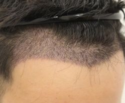 -大麦微针植发全国连锁