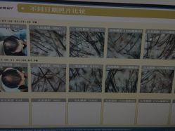 -大麦微针植发全国连锁