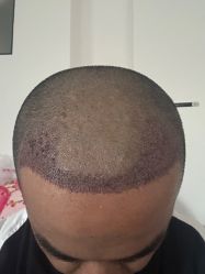 -碧莲盛·不剃发植发