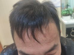 -碧莲盛·不剃发植发