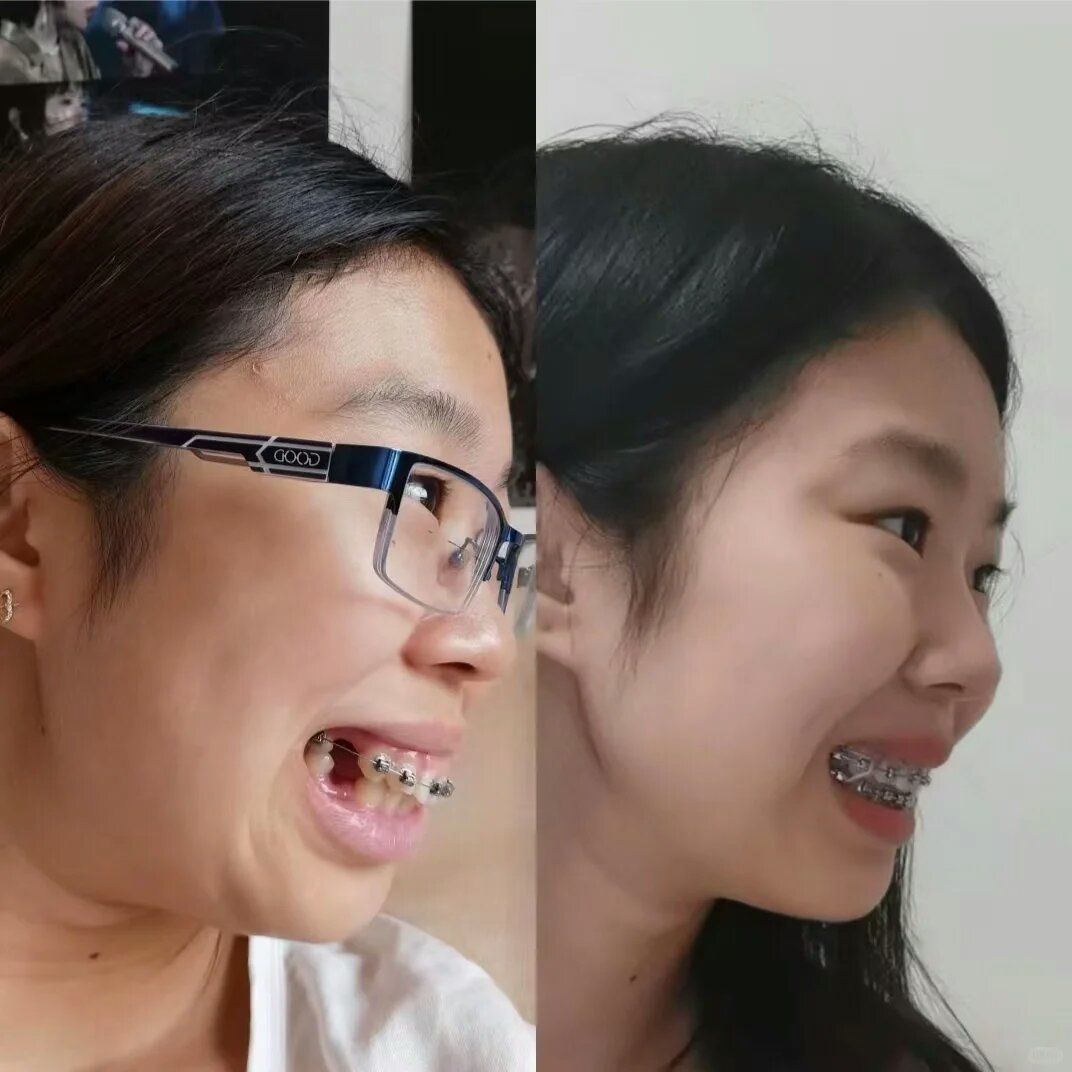 我的牙不飞啦