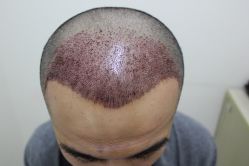 点击看大图 -大麦微针植发丨全国连锁