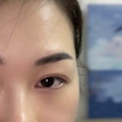体验后-广州健丽·去眼袋医疗美容机构
