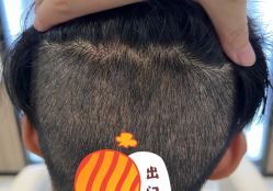 -大麦微针植发全国连锁