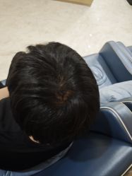 -大麦微针植发丨全国连锁