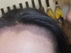 -碧莲盛·不剃发植发