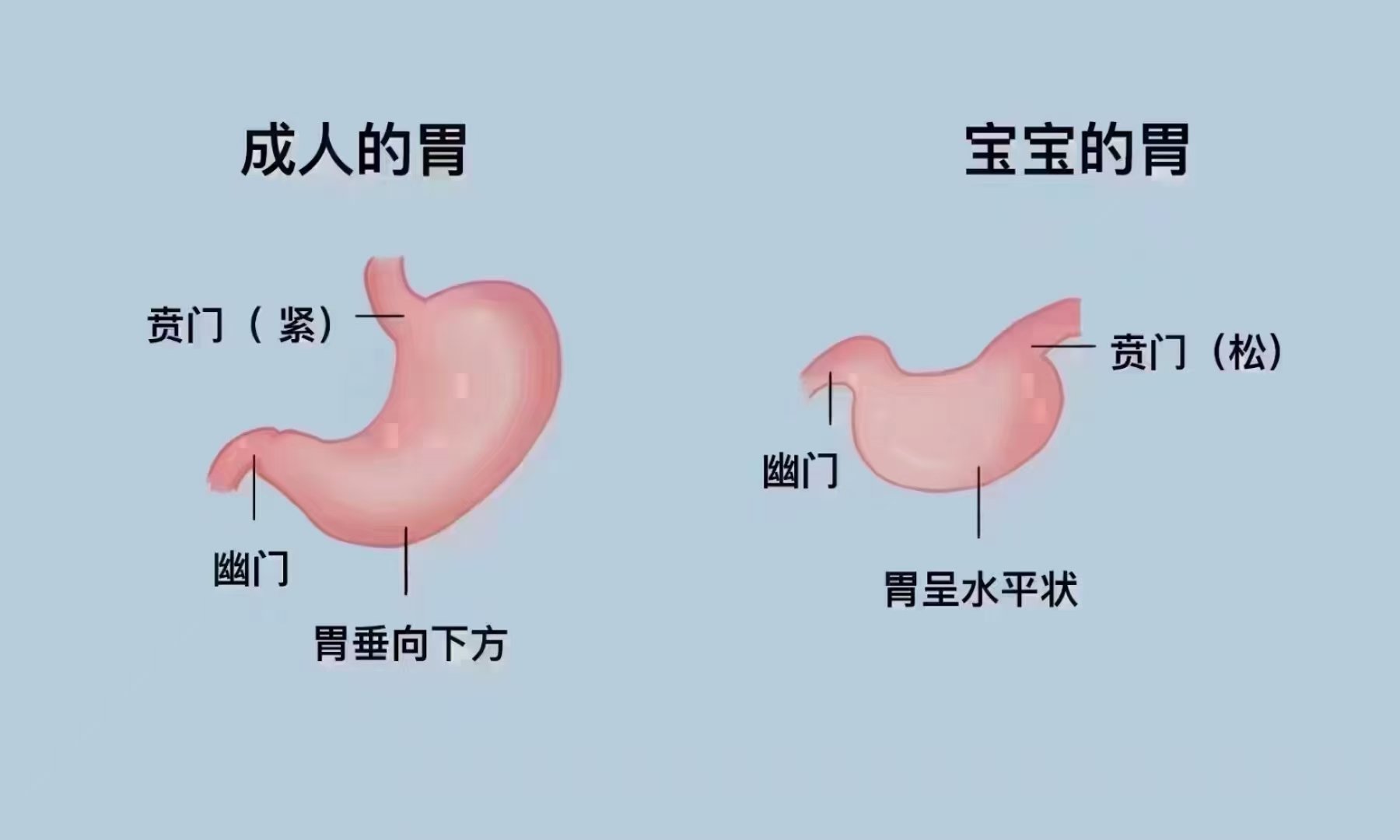 儿童幽门梗阻图片