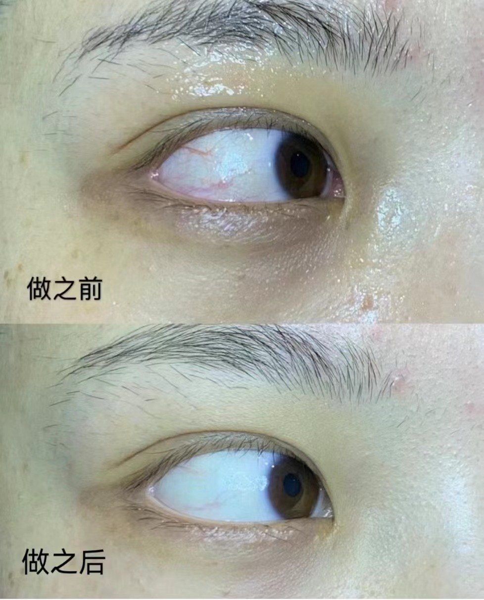 蓝精灵眼护