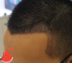 -大麦微针植发丨全国连锁