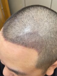 -大麦微针植发全国连锁