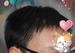 -大麦微针植发丨全国连锁