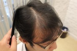 点击看大图 -大麦微针植发丨全国连锁