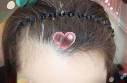 -大麦微针植发全国连锁