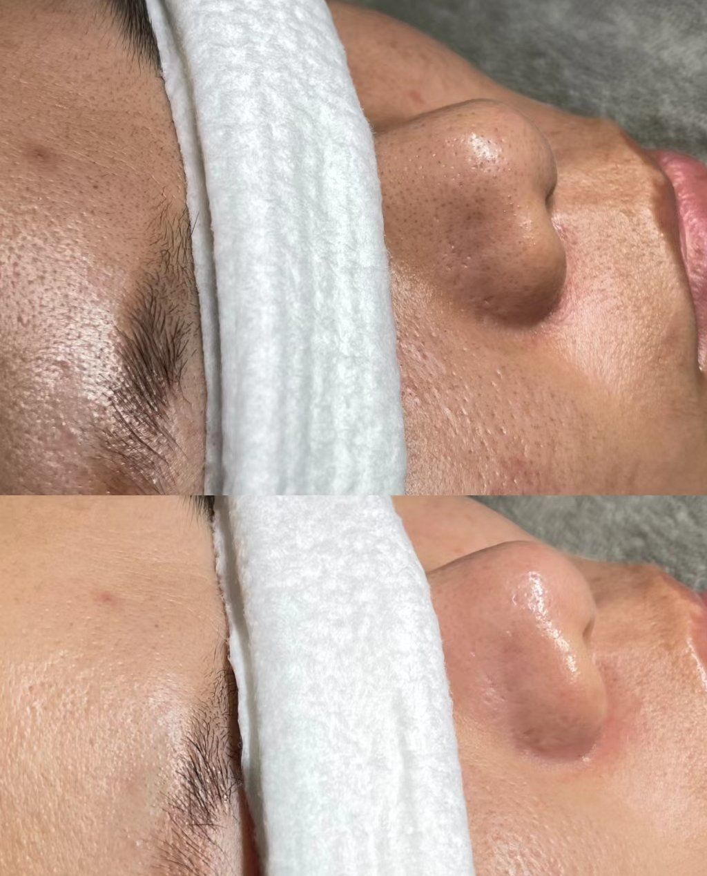 黑头清洁对比图