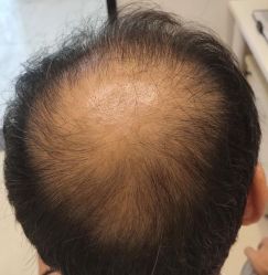 点击看大图 -大麦微针植发丨全国连锁