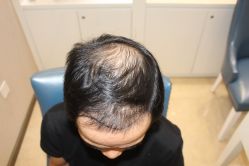 -大麦微针植发丨全国连锁