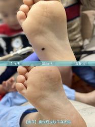 -清疣美疣·痣·斑净肤中心