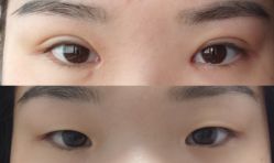 体验前-苏州维多利亚美容医院