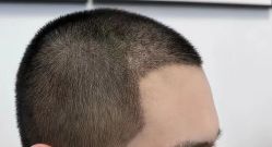 体验后-熙朵美学植发·连锁品牌