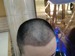 -碧莲盛·不剃发植发