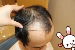 -大麦微针植发丨全国连锁