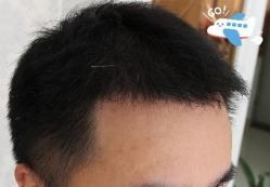 -大麦微针植发丨全国连锁