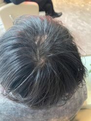 -碧莲盛·不剃发植发