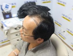 -大麦微针植发丨全国连锁