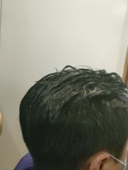 点击看大图 -碧莲盛·不剃发植发