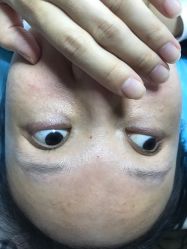 -爱莎扁平疣·汗管瘤·斑痣中心