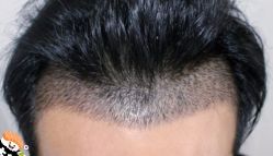 -大麦微针植发丨全国连锁