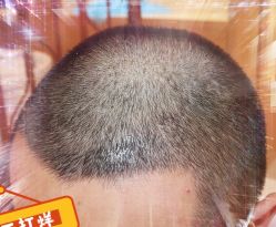 -大麦微针植发全国连锁