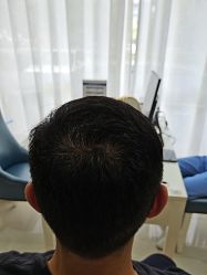 -大麦微针植发丨全国连锁