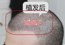 -大麦微针植发全国连锁