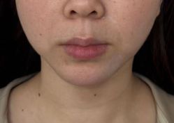 体验前-洁铭新加坡医美