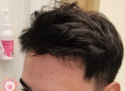 -大麦微针植发丨全国连锁