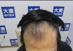 -大麦微针植发丨全国连锁