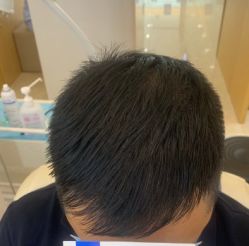 -大麦微针植发全国连锁